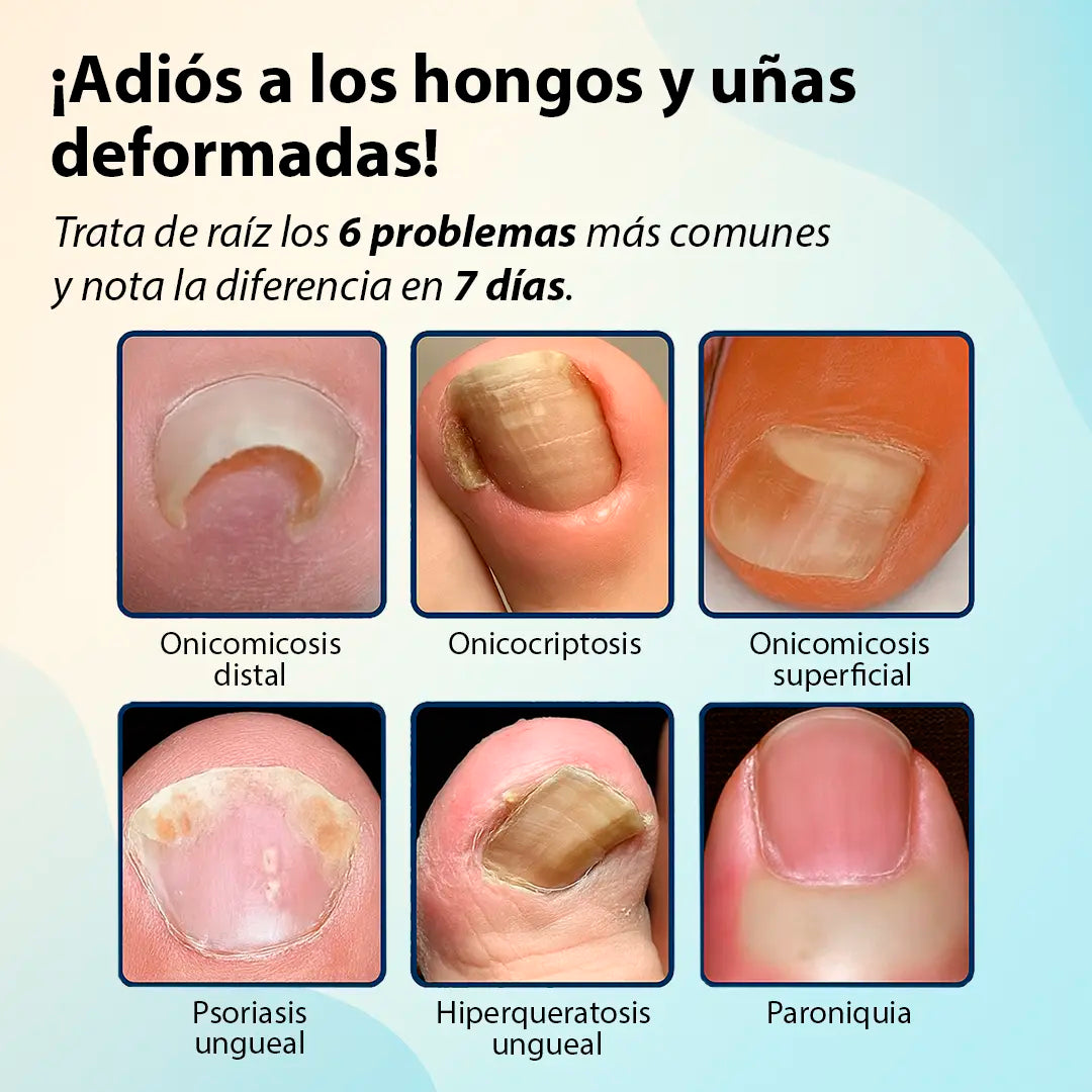 ToenailPlus™ – El fin de los hongos, bacterias y uñas encarnadas