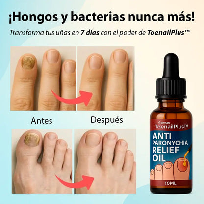 ToenailPlus™ – El fin de los hongos, bacterias y uñas encarnadas
